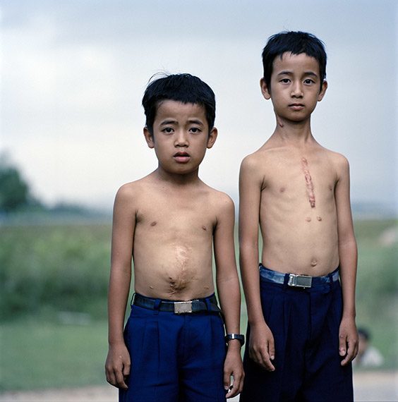 Pham Van Diep, 12, right, and his brother, Pham Van Duc, 10. The boys live near Da Nang, Vietnam, an area heavily sprayed with defoliants during the Vietnam War, and both have undergone numerous medical procedures to correct ailments doctors attribute to dioxin contamination. The places in Vietnam that were heavily sprayed with Agent Orange, an herbicide that contains dioxins, have a birth defect rate of 2.4 percent, significantly higher than the national average of 0.6 percent. Diep says his friends all think his scars are the result of a fight. He doesn’t correct them.